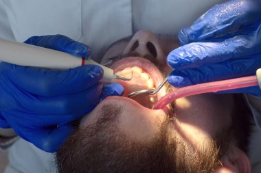 Diş hekimi ultrasonik diş temizliği yapıyor. Tartar ve plaketin çıkarılması. Diş hastalıklarının önlenmesi paradontit ve paradantoz