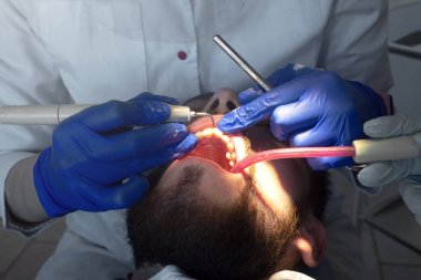 Diş hekimi ultrasonik diş temizliği yapıyor. Tartar ve plaketin çıkarılması. Diş hastalıklarının önlenmesi paradontit ve paradantoz. 