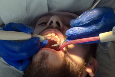 Diş hekimi ultrasonik diş temizliği yapıyor. Tartar ve plaketin çıkarılması. Diş hastalıklarının önlenmesi paradontit ve paradantoz