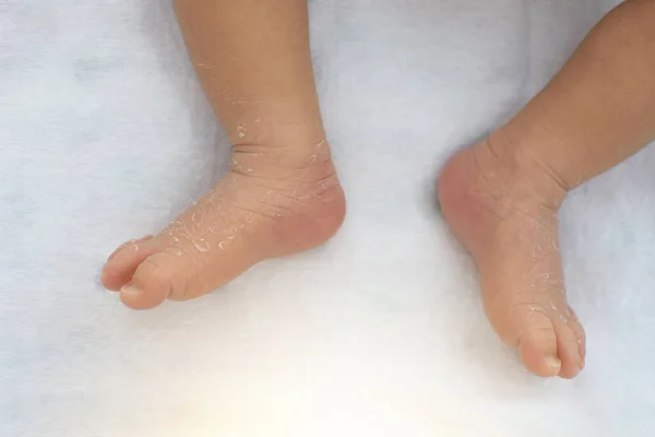 新生婴儿脚的皮在白布上的皮 — 图库照片