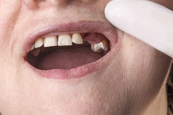 Onderzoek Van Mondholte Bij Tandarts Tijdelijke Tandvulling Tanden Uitgetrokken — Stockfoto