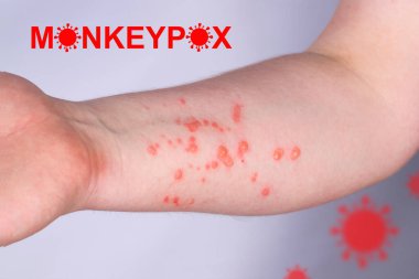 Hand of a young guy in a rash. Monkeypox virus symptoms. clipart