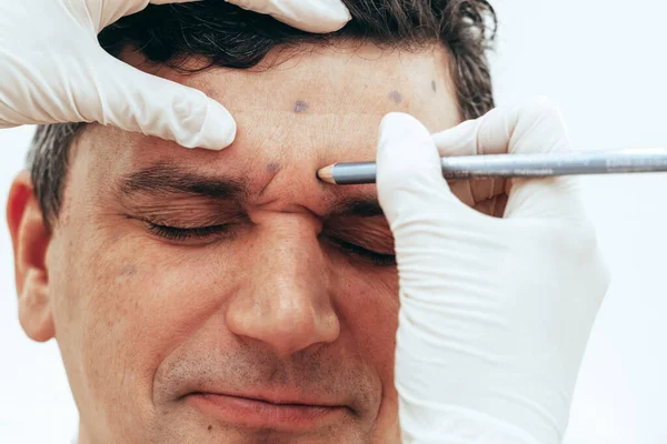 Лікар-косметолог готує чоловіче обличчя до ін'єкцій ботокса, процедуру омолодження, застосовує точки, в салоні краси Стокове Зображення