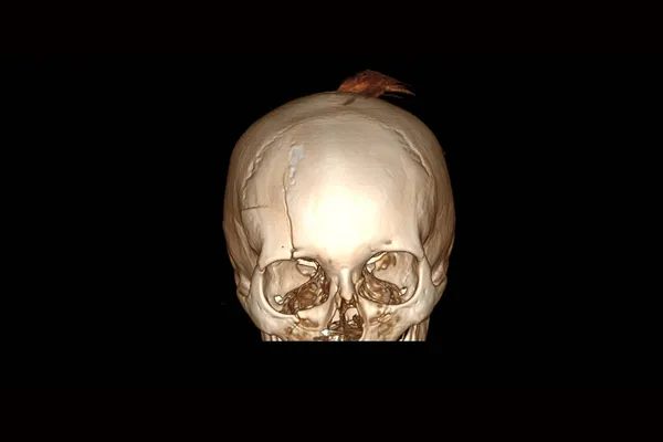 頭蓋骨の額が割れた後頭蓋骨の断層撮影 頭蓋骨骨折 頭蓋骨の3Dコンピュータ断層撮影 — ストック写真