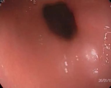 Akut bağırsak iltihabı ve gastroskobu olan bir adamda bağırsak gastroskopisi.