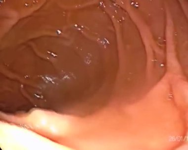 Akut bağırsak iltihabı ve gastroskobu olan bir adamda bağırsak gastroskopisi.