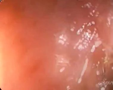 Akut bağırsak iltihabı ve gastroskobu olan bir adamda bağırsak gastroskopisi.