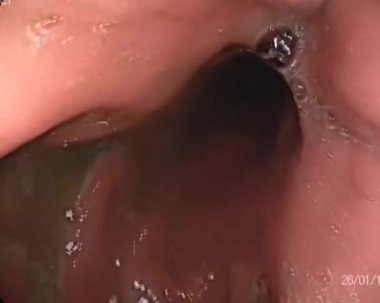 Akut bağırsak iltihabı ve gastroskobu olan bir adamda bağırsak gastroskopisi.