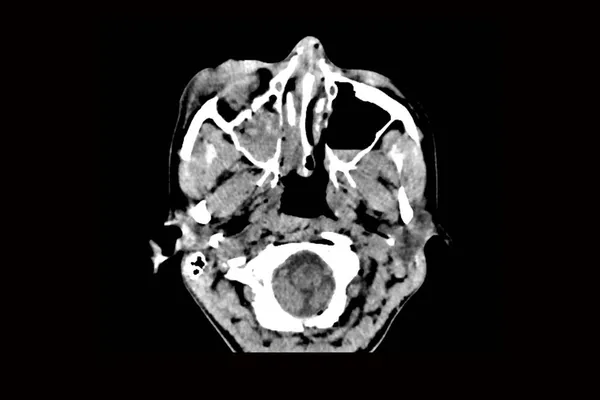 Tomografia Komputerowa Mózgu Złamaniem Przedniej Części Czaszki Urazie Odwróceniem Czaszki — Zdjęcie stockowe