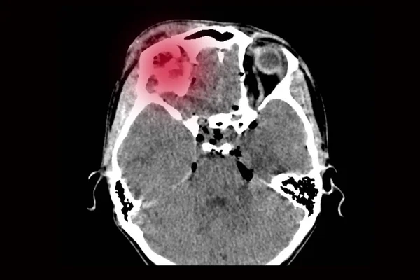 傷害を受けた後頭蓋骨の前頭葉が破壊された脳の断層撮影自転車から転落した後頭部の頭蓋骨の反転 — ストック写真