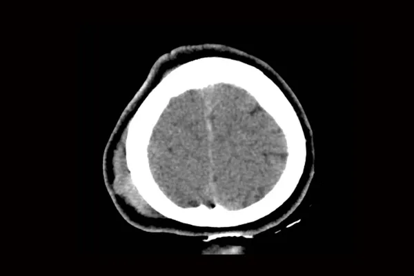 Tomografia Computadorizada Cérebro Com Fratura Parte Frontal Crânio Após Lesão — Fotografia de Stock