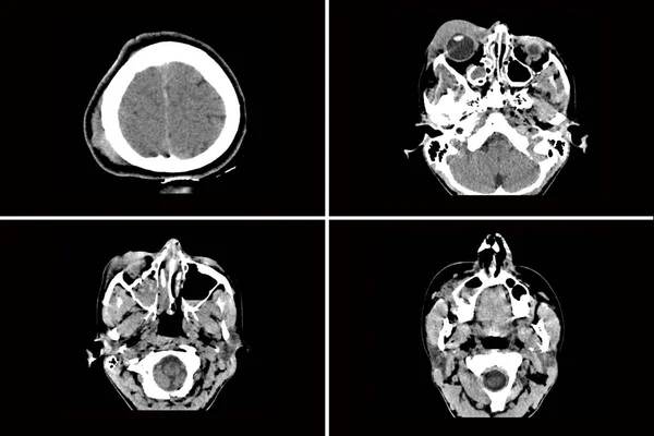 Computed Tomography Brain Fracture Frontal Part Skull Receiving Injury Reversal — Stock Photo, Image