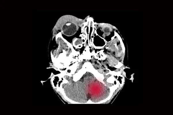 Tomografia Komputerowa Mózgu Złamaniem Przedniej Części Czaszki Urazie Odwróceniem Czaszki — Zdjęcie stockowe