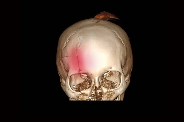 傷害を受けた後の頭蓋骨の正面部分の骨折 自転車から落ちた後の頭の頭蓋骨の反転と脳の3Dコンピュータ断層撮影 — ストック写真