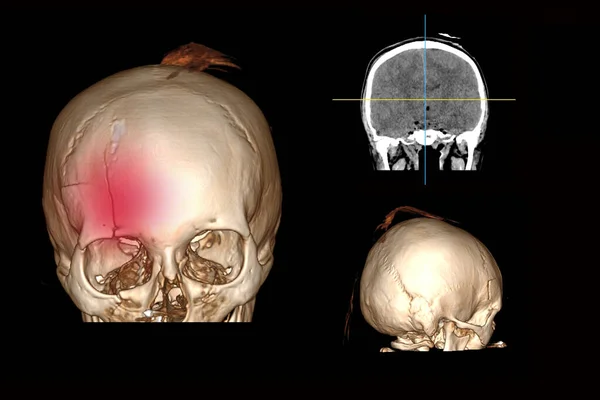 Tomografia Computadorizada Cérebro Com Uma Fratura Parte Frontal Crânio Após — Fotografia de Stock