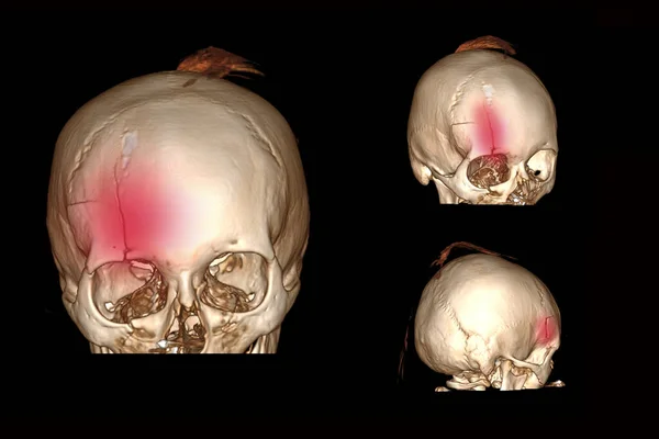 傷害を受けた後の頭蓋骨の正面部分の骨折 自転車から落ちた後の頭の頭蓋骨の反転と脳の3Dコンピュータ断層撮影 — ストック写真
