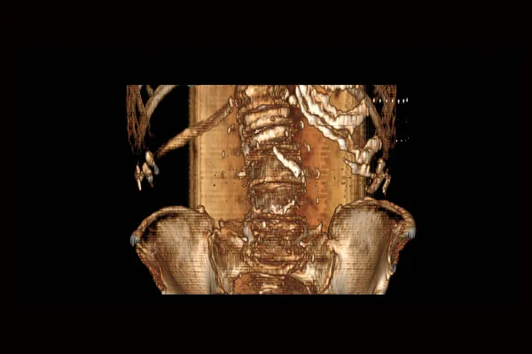 척추의 과타오 고사람으로 부터의 절증으로 척추의 — 스톡 사진