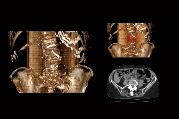 Tomografia Computadorizada Coluna Vertebral Com Fratura Das Vértebras Seu Deslocamento — Fotografia de Stock