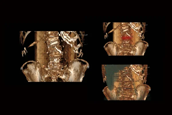 Datortomografi Ryggraden Med Fraktur Kotorna Och Deras Förskjutning Från Taorogo — Stockfoto