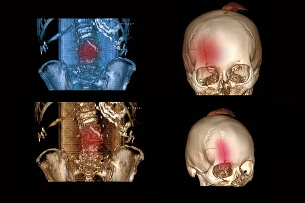 椎骨の骨折とその人からの脱臼と額に骨折がある頭蓋骨の断層撮影収縮と骨症の脊椎の骨折 — ストック写真