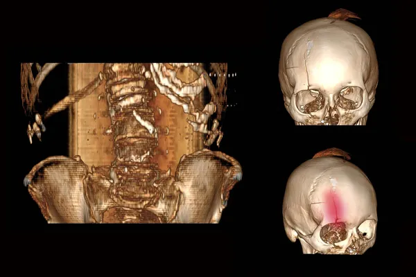 Computed Tomography Spine Fracture Vertebrae Displacement Person Skull Fracture Forehead Stock Photo