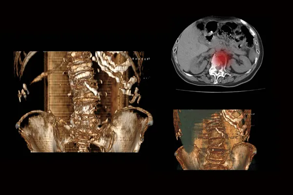 Комп'ютерна томографія хребта з переломом хребців та їх зміщенням від тахогенезу людини, перелом хребців зі скороченням — стокове фото