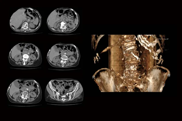 Комп'ютерна томографія хребта з переломом хребців та їх зміщенням від тахогенезу людини, перелом хребців зі скороченням — стокове фото