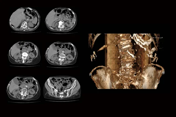 A gerinc komputertomográfiája a csigolyatöréssel és azok elmozdulásával egy taorogo személytől, a csigolyák törése összehúzódással — Stock Fotó