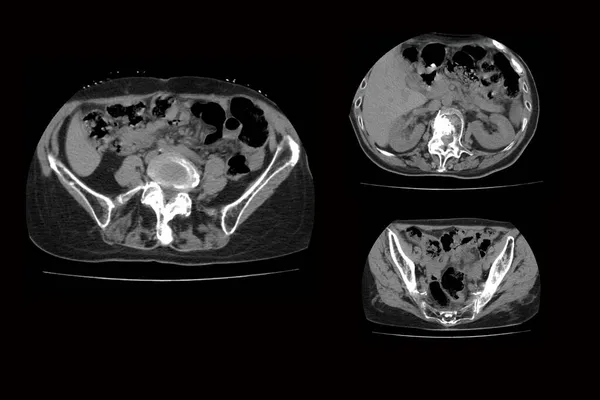 Tomografia Computadorizada Coluna Vertebral Com Fratura Das Vértebras Seu Deslocamento — Fotografia de Stock