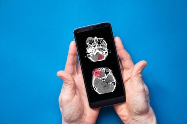 Düşmeden sonra kafatası tomografisi, kafatası kırığı, telefonun elindeki 3 boyutlu kafatası tomografisi, mobil uygulama.