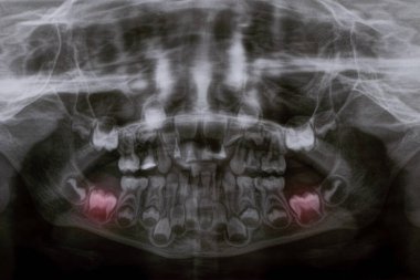 Bir panoramik X-ray çocuk dişlerinin hem üst hem de alt çenesinde çeşitli gömülü ve çarpık dişler gösterir
