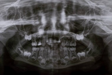 Bir panoramik X-ray çocuk dişlerinin hem üst hem de alt çenesinde çeşitli gömülü ve çarpık dişler gösterir