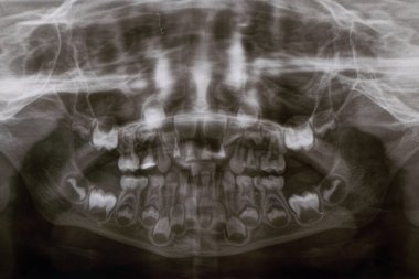 Bir panoramik X-ray çocuk dişlerinin hem üst hem de alt çenesinde çeşitli gömülü ve çarpık dişler gösterir