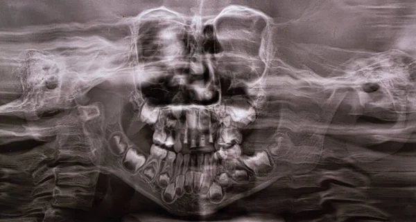 Panoramaröntgen Visar Flera Inbäddade Och Påverkade Tänder Både Övre Och — Stockfoto
