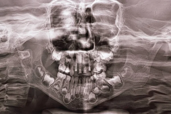 Uma Radiografia Panorâmica Mostra Vários Dentes Embutidos Impactados Mandíbula Superior — Fotografia de Stock