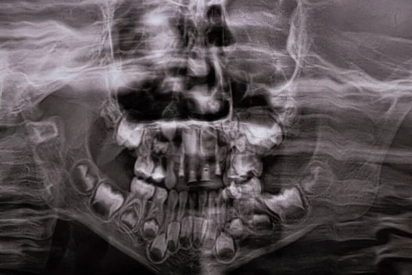 Una Radiografía Panorámica Muestra Varios Dientes Incrustados Impactados Mandíbula Superior — Foto de Stock