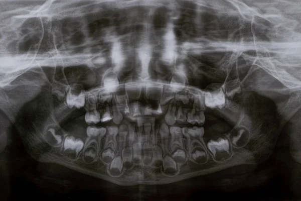 Una Radiografía Panorámica Muestra Varios Dientes Incrustados Impactados Mandíbula Superior — Foto de Stock