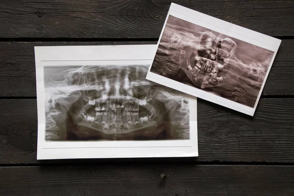 Una Radiografía Panorámica Muestra Varios Dientes Incrustados Impactados Mandíbula Superior —  Fotos de Stock