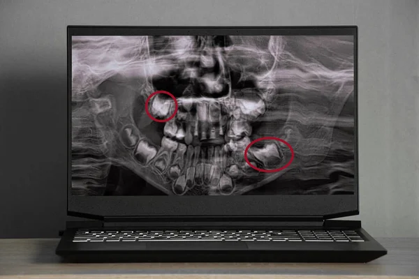 Panoramische Röntgenfoto Van Kindertanden Van Twee Kaken Orthopantomogram Van Kindertanden — Stockfoto