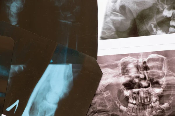 Röntgenstrålar Kvinnas Hand Med Fraktur Röntgen Hälsovård Och Medicin — Stockfoto