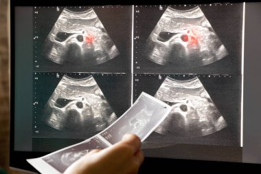 Bir kadının karın ultrasonu dizüstü bilgisayar ekranında doktorun ofisinde, karın ağrısı teşhisi, ilaç...