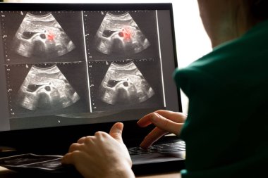 Bir kadının karın ultrasonu dizüstü bilgisayar ekranında doktorun ofisinde, karın ağrısı teşhisi, ilaç...