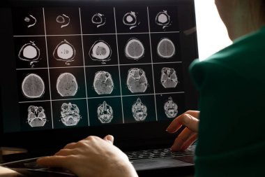 3 boyutlu beyin tomografisi. Doktorun ofisindeki dizüstü bilgisayar ekranlarında yaralanma sonrası kafatasının ön kısmında kırık var.