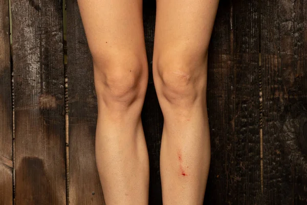 木製の板の背景に落下した後 足に傷を持つ女性の足 足に傷 怪我や治療 — ストック写真