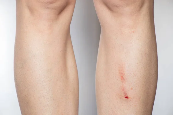 Female Leg Scratch Fall White Background Wound Leg Blood — 스톡 사진