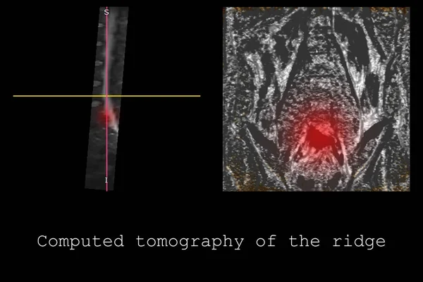 Computed Tomography Spine Young Man Dorsal Intervertebral Hernia Diagnosis Detection — 스톡 사진