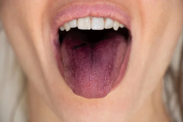 Red Tongue Mulberry Open Mouth Tongue Girl Close — Stock Photo, Image