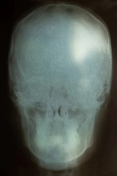 Old x-ray of a female skull close-up, examination of the skull, diagnosis
