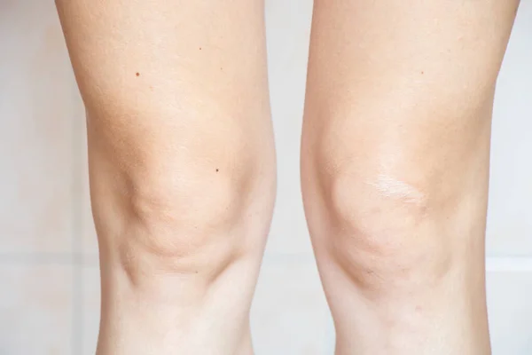 Knee Young Girl Old Scar Close Legs Knees — 스톡 사진
