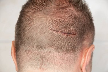 Large scratch on the head of a man from falling head on a corner in the pool, a wound from hitting his head, medicine and emergency care